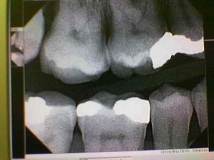 teeth-cavities.jpg