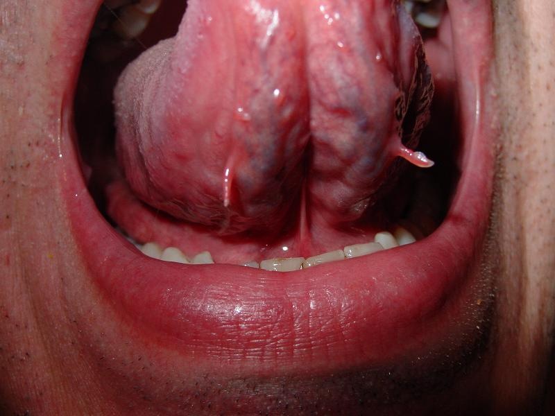 Swelling Under My Tongue - Dental Health.